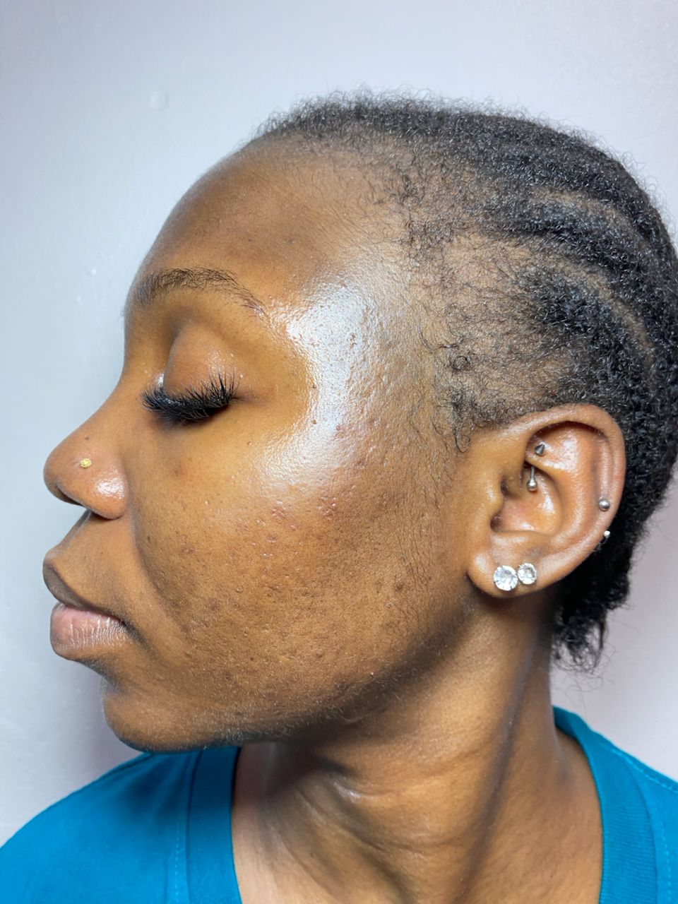 Acne Recovery after