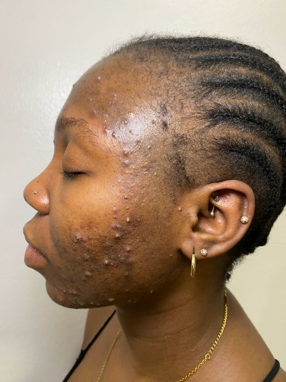 Acne Recovery before