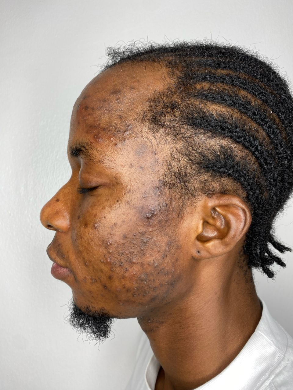 Pigmentation Balance before